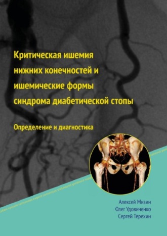 Критическая ишемия нижних конечностей и ишемические формы синдрома диабетической стопы. Алексей Мизин