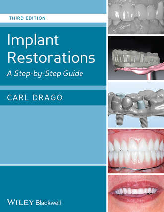 Carl  Drago. Implant Restorations. A Step-by-Step Guide