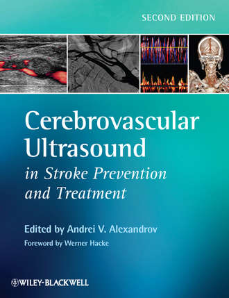 Hacke Werner. Cerebrovascular Ultrasound in Stroke Prevention and Treatment