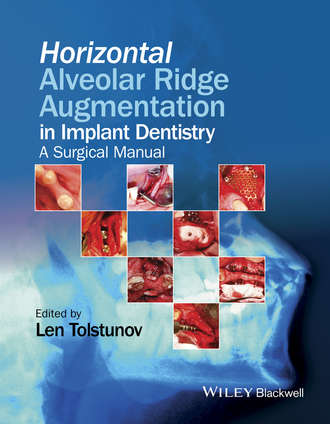 Len Tolstunov. Horizontal Alveolar Ridge Augmentation in Implant Dentistry