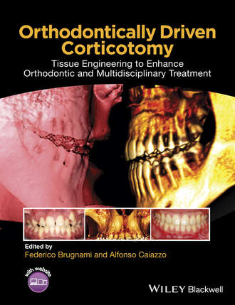 Orthodontically Driven Corticotomy. Группа авторов