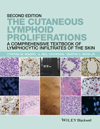 The Cutaneous Lymphoid Proliferations. A. Neil Crowson