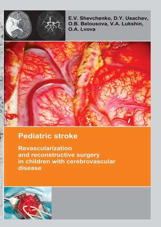 E. V. Shevchenko. Pediatric stroke. Revascularization and reconstructive surgery in children with cerebrovascular disease