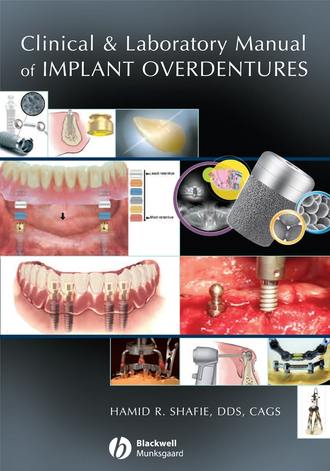 Группа авторов. Clinical and Laboratory Manual of Implant Overdentures