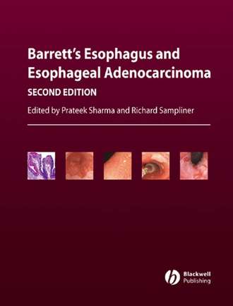 Prateek  Sharma. Barrett's Esophagus and Esophageal Adenocarcinoma