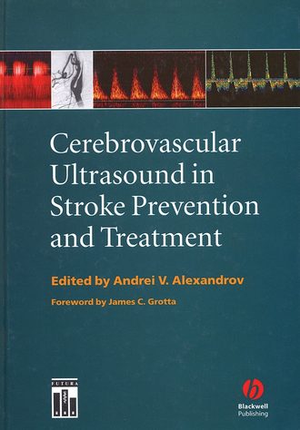 Andrei Alexandrov V.. Cerebrovascular Ultrasound in Stroke Prevention and Treatment