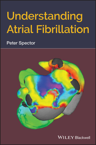 Peter Spector. Understanding Atrial Fibrillation