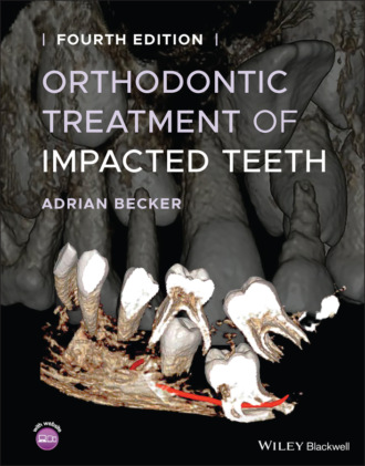 Orthodontic Treatment of Impacted Teeth. Adrian Becker