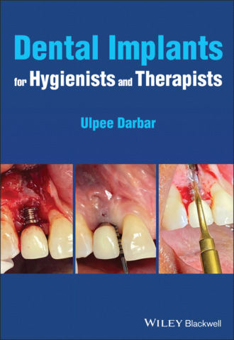 Dental Implants for Hygienists and Therapists. Ulpee R. Darbar