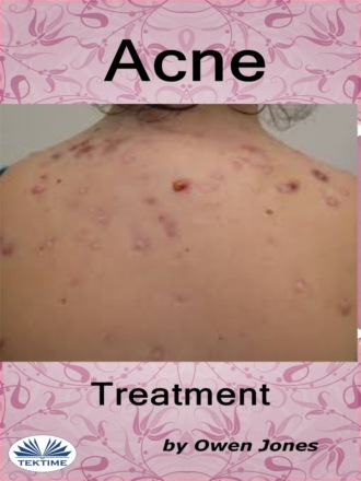 Acne Treatment. Оуэн Джонс