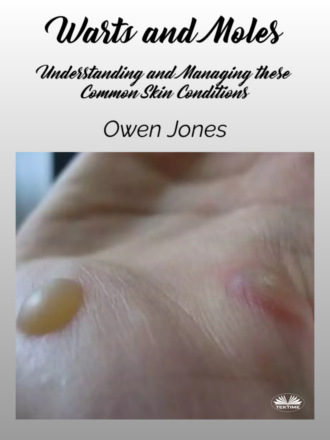 Оуэн Джонс. Warts And Moles