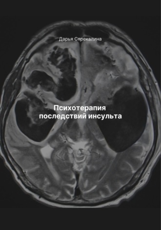Дарья Владимировна Стрекалина. Психотерапия последствий инсульта