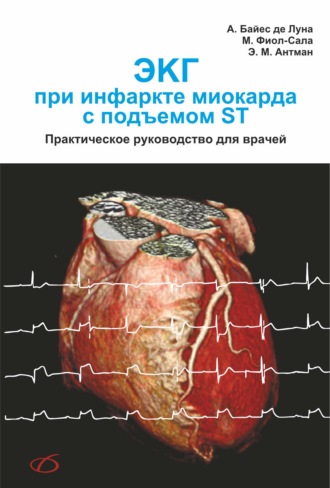 ЭКГ при инфаркте миокарда с подъемом ST. А. Байес де Луна